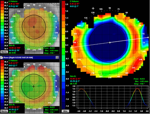 Non-Surgical Alternative to LASIK