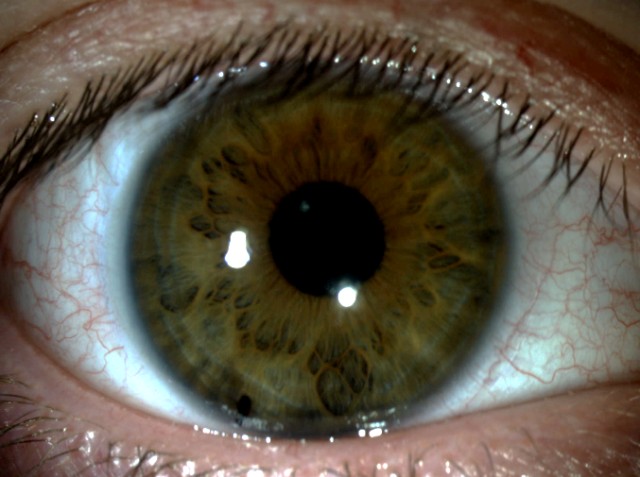 Anterior Segment Eye Image OD