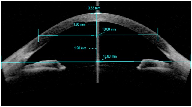 Anterior Segment Ocular Coherence Tomography (OCT)